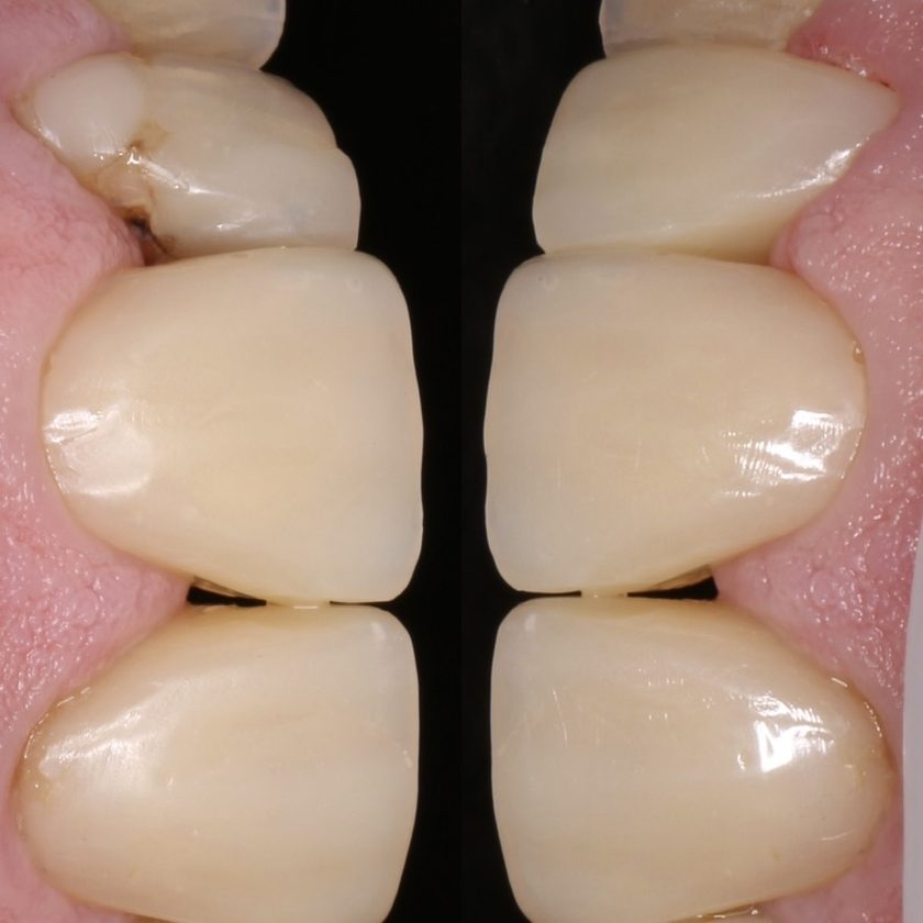 Close-up of front teeth: a natural-looking aesthetic result