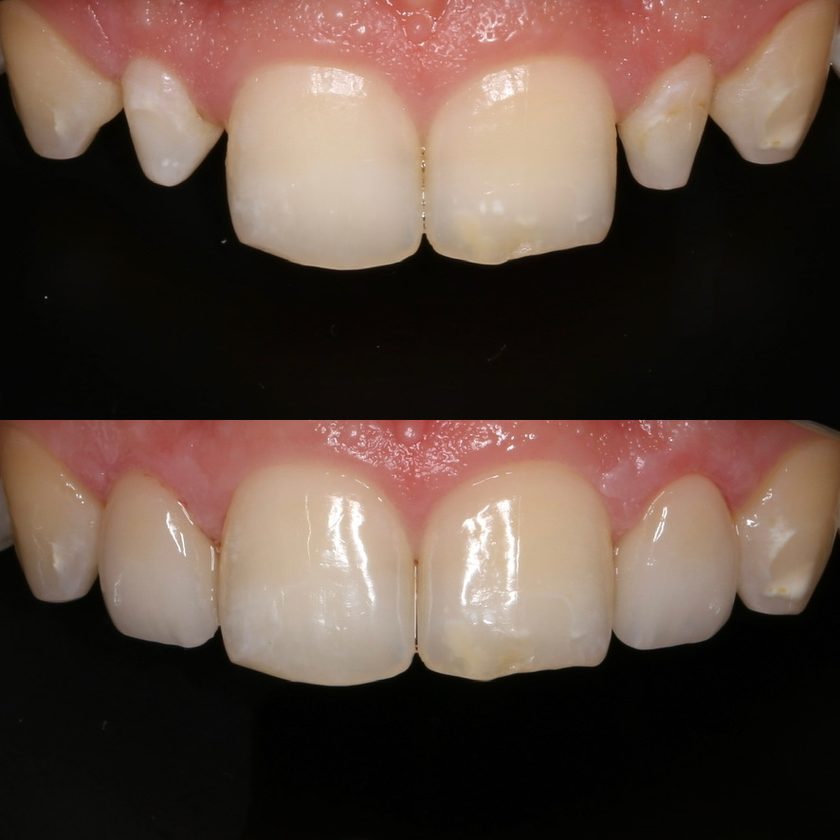 Aesthetic restoration of the front teeth: before above, finished result below