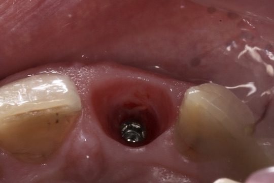 Dental implant healing phase: implant placed in the site of an extracted tooth
