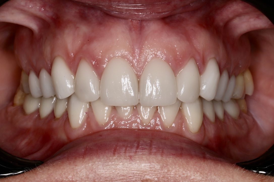 Extensive aesthetic rehabilitation: ceramic crowns in the upper and lower jaw