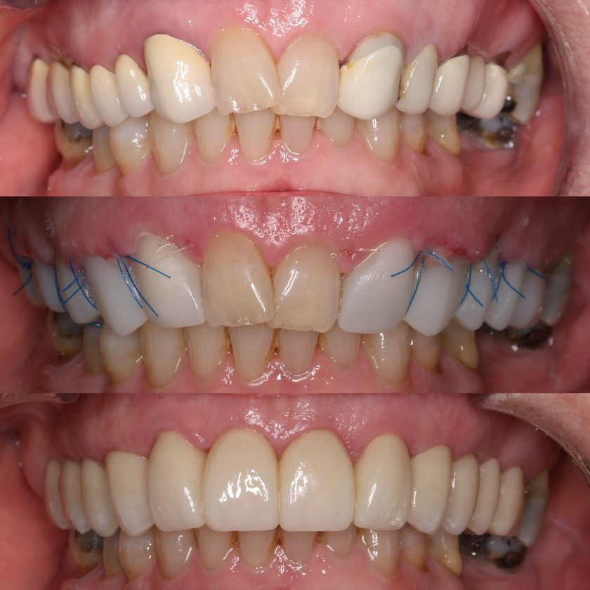 Full-arch prosthodontic treatment: initial situation, healing phase with sutures, and the final ceramic result